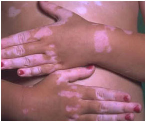 Vitiligo Treatment NHS